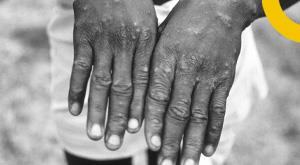 strains-of-monkeypox-found-in-us