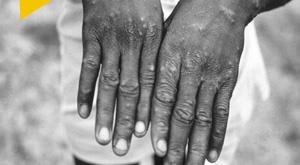 who-risk-monkeypox-emergence-non-endemic-countries