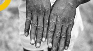 cdc-monkeypox-spreads-air-face-contact