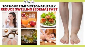 top-home-remedies-to-naturally-reduce-swelling-edema-fast