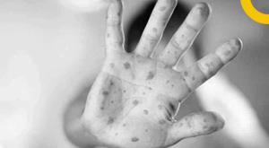 tomato-fever-confusing-name-of-hand-footh-and-mouth-disease-in-india