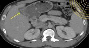 hepatitis-cases-children-draw-concern-usa