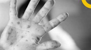 symptoms-like-depressiondelusion-in-monkeypox-patients-know-the-identity