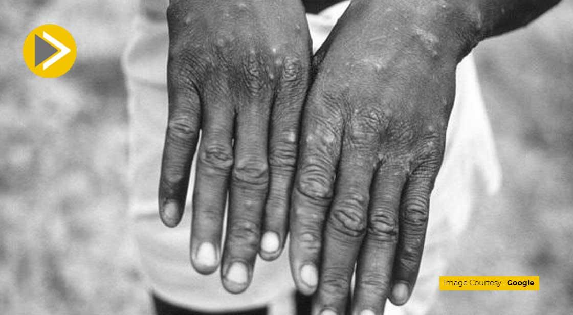 CDC Says Monkeypox Only Spreads through Air During Face to Face Contact