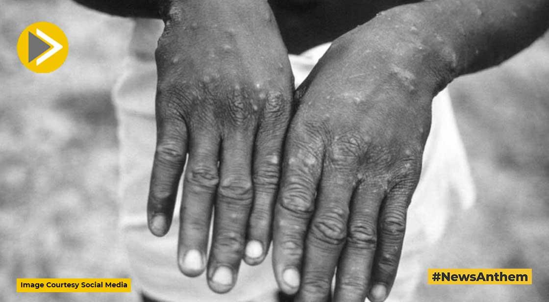 केरल में मिला देश का Monkeypox का पहला केस, केंद्र से भेजी गई टीम