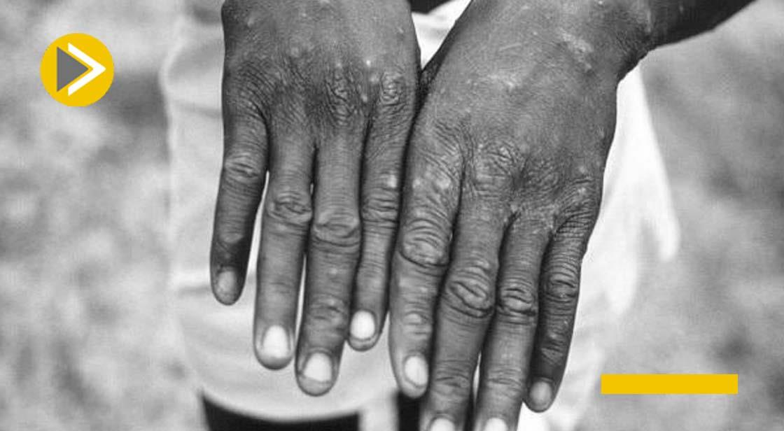WHO Says Risk of Monkeypox Emergence in non-endemic countries