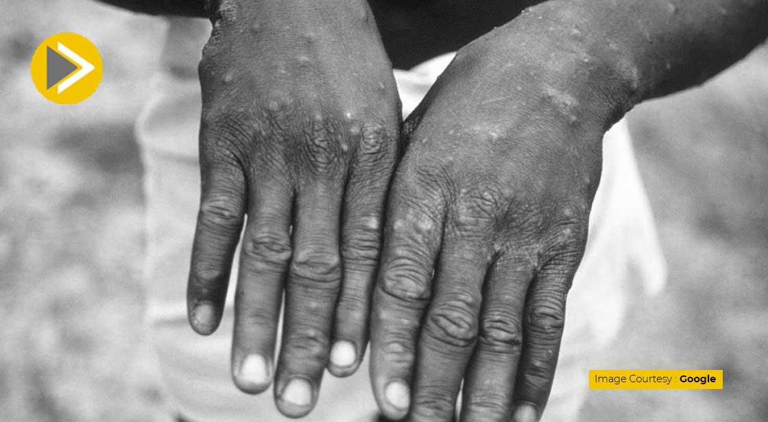 2 Strains of Monkeypox Found in US