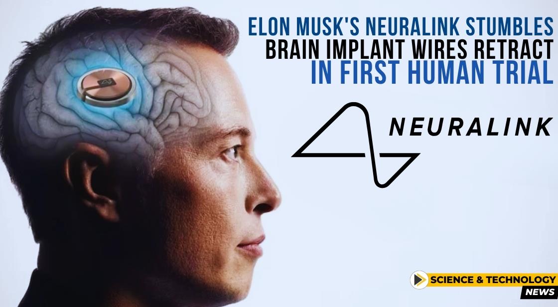Elon Musk's Neuralink Stumbles: Brain Implant Wires Retract in First Human Trial